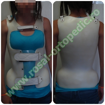 Corset de Boston - Scoliose correction, Corset polyéthylène (plastique  thermoformable)